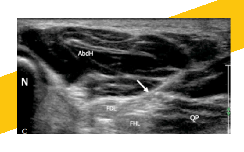 6. Musculatura intrinseca pie ecografia tempo formacion.png